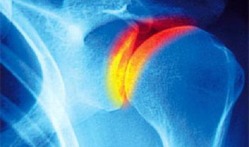 Как лечить артроз плечевого сустава
