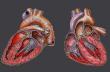 Как лечить порок сердца